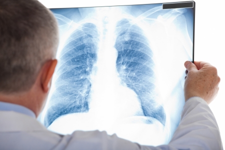 У Кременчуці смертність від туберкульозу збільшилась у 2 рази