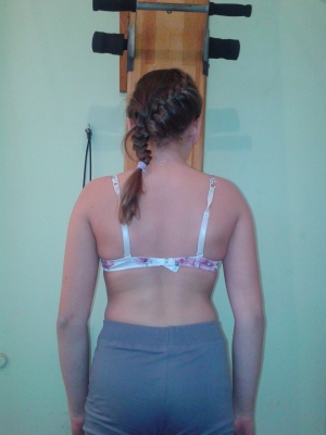 Лечение сколиоза у детей по программе «Осанка»