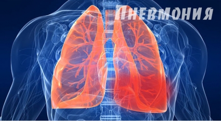 Ще один кременчужанин помер від пневмонії