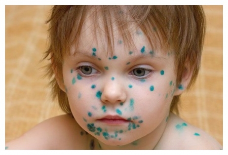 На 46,6% збільшилась захворюваність на вітрянку у Кременчуці На 46,6% збільшилась захворюваність на вітрянку у Кременчуці