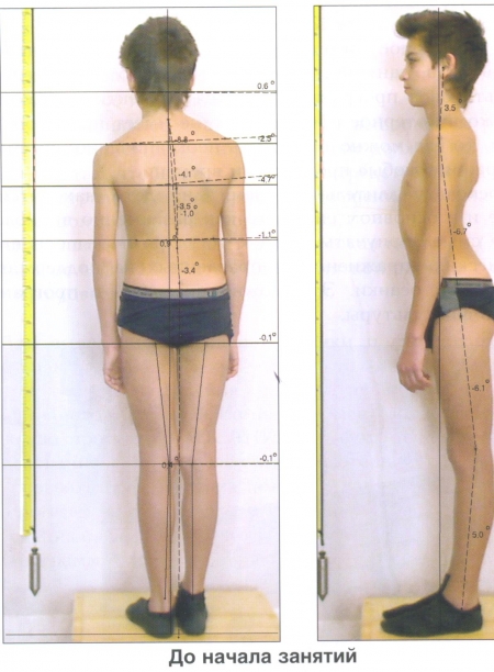 Чем опасен сколиоз у детей