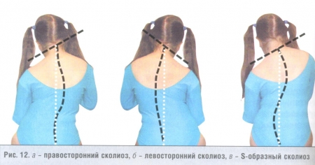 Чем опасен сколиоз у детей