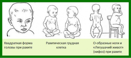 Як вберегти дитину від рахіту у похмуру погоду