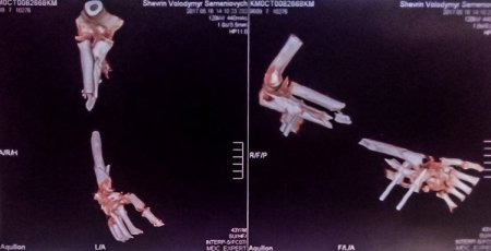 Кременчуцький боєць з позивним «Таксист» потребує вартісного лікування