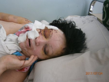 Кременчужанка Галина Михайленко, яка постраждала в ДТП, потребує допомоги