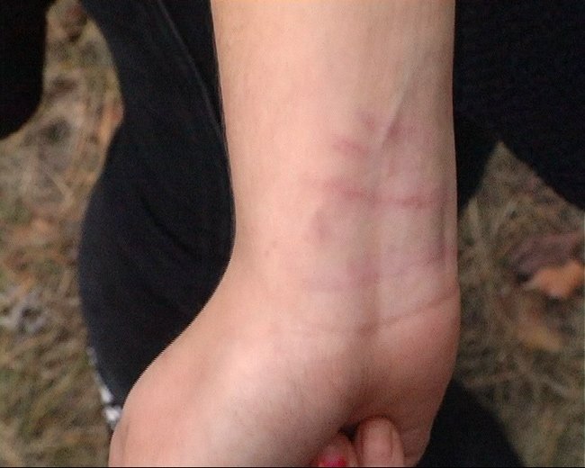 Сверстницы резале пострадавшей запястье в области вены Сверстницы резале пострадавшей запястье в области вены