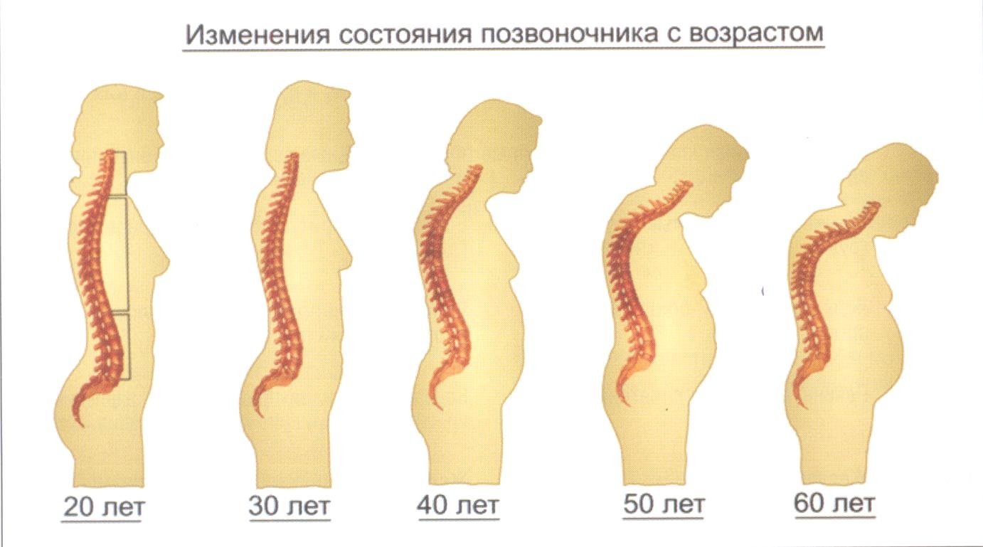 Чем опасен сколиоз у детей Чем опасен сколиоз у детей