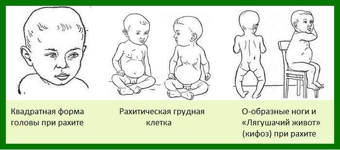 Як вберегти дитину від рахіту у похмуру погоду Як вберегти дитину від рахіту у похмуру погоду