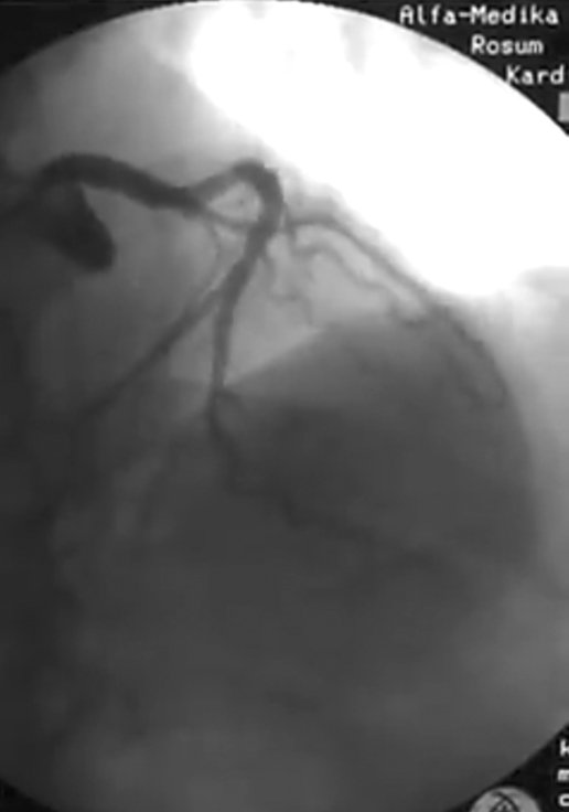 Кому из кременчужан стент достанется бесплатно Кому из кременчужан стент достанется бесплатно