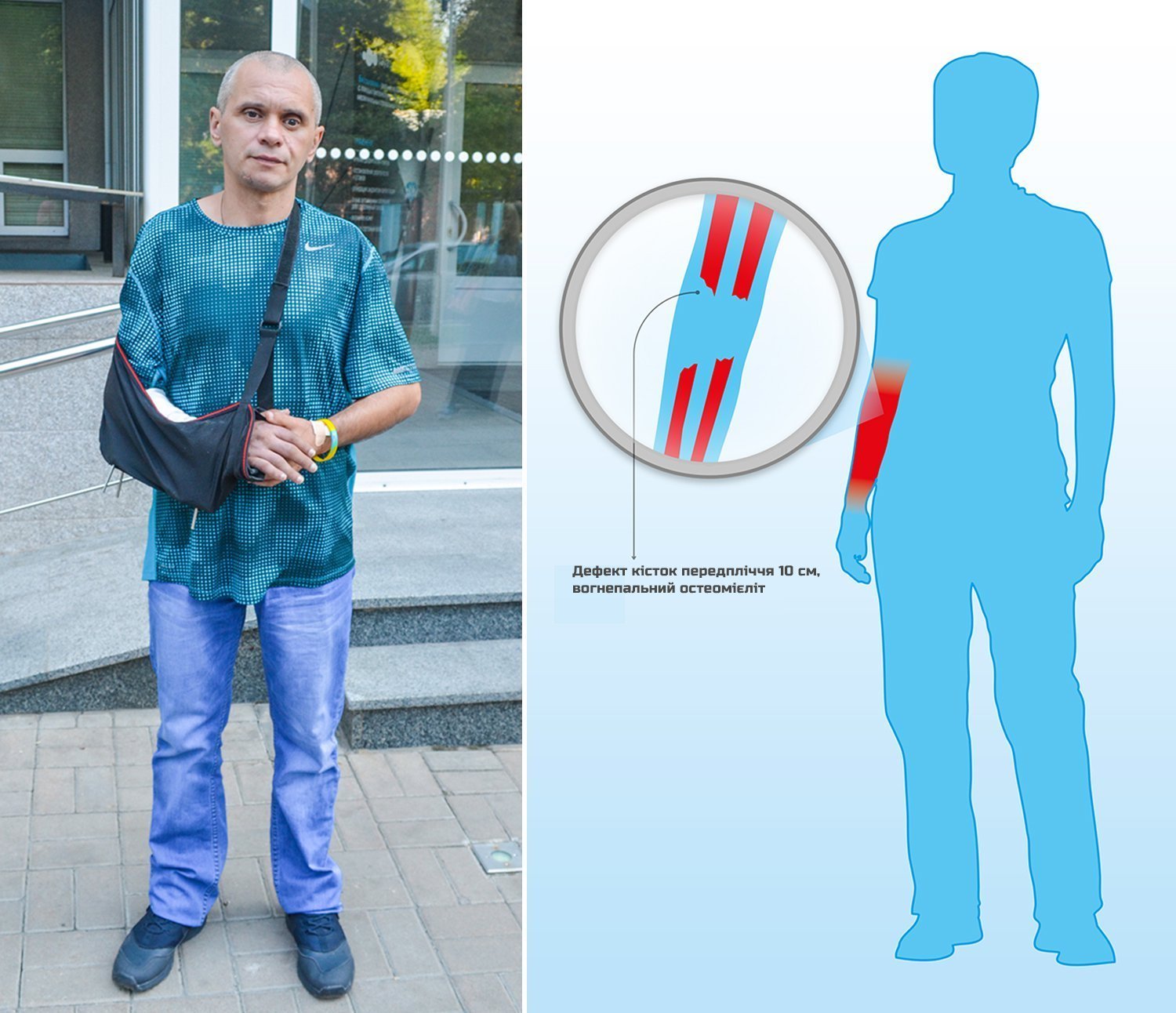 Кременчуцький боєць з позивним «Таксист» потребує вартісного лікування Кременчуцький боєць з позивним «Таксист» потребує вартісного лікування