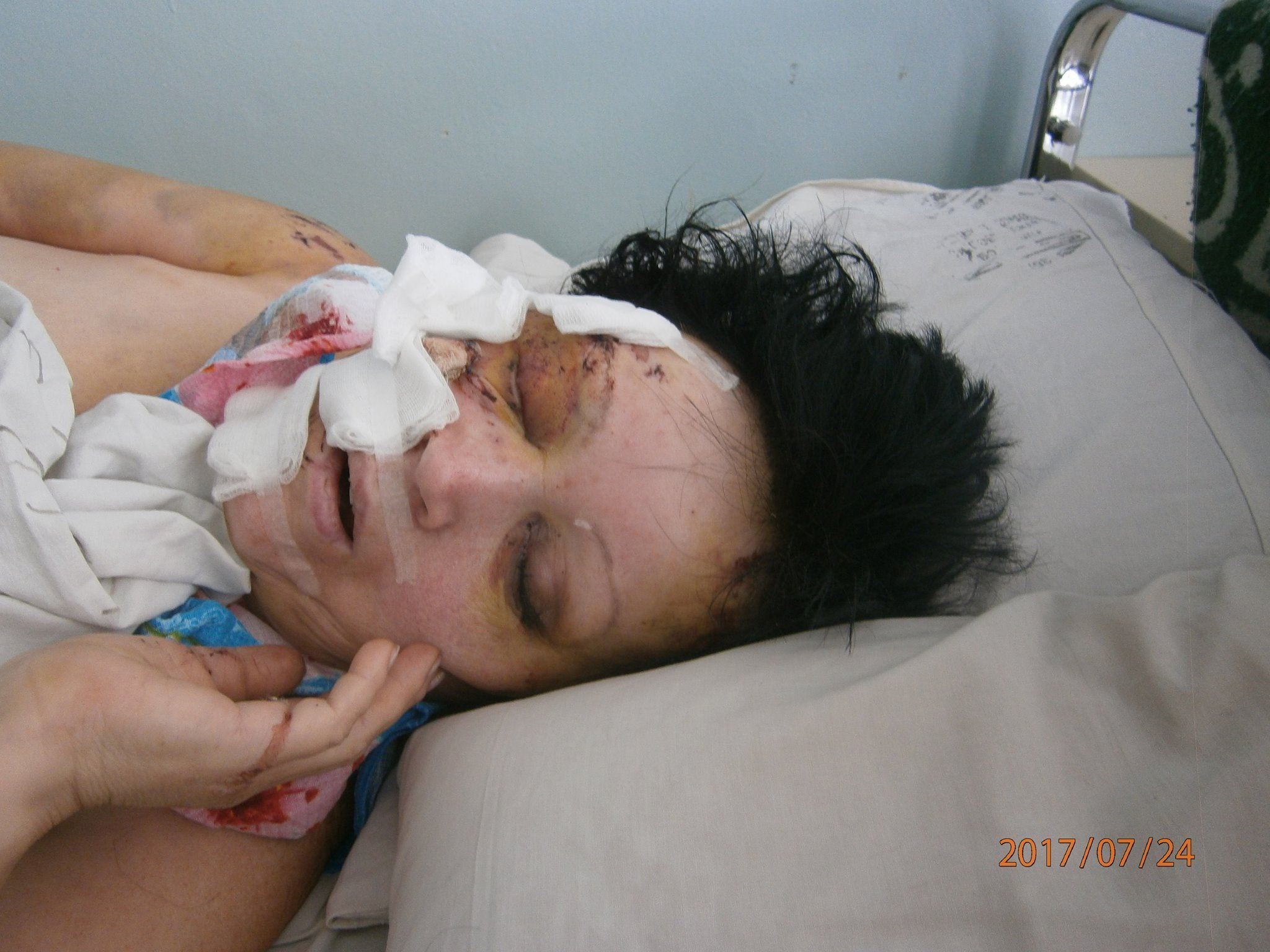 Кременчужанка Галина Михайленко, яка постраждала в ДТП, потребує допомоги Кременчужанка Галина Михайленко, яка постраждала в ДТП, потребує допомоги