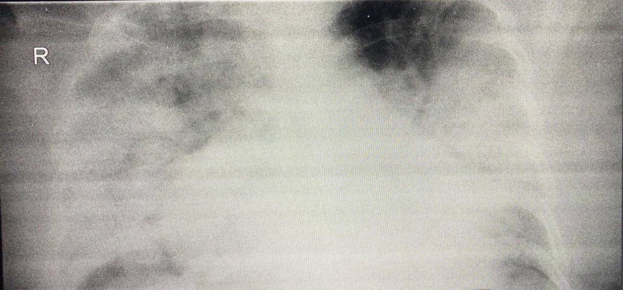 Уражені легені з чорною плямою реального пацієнта з ковідного шпиталю