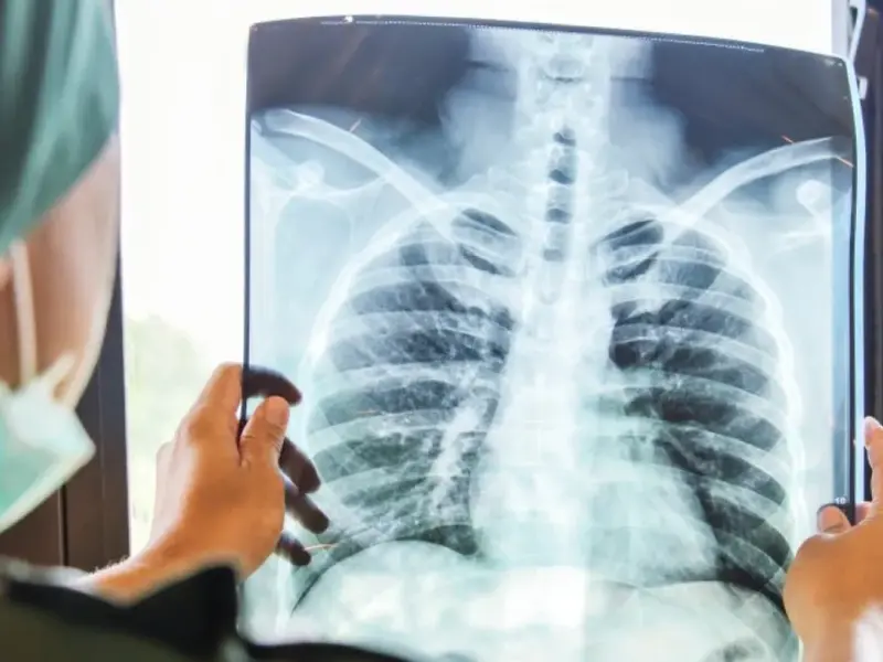 На Полтавщині захворюваність на туберкульоз зменшилася майже на 20%